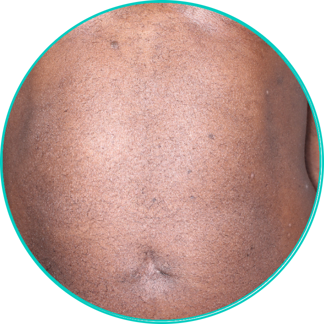 Patient Results for Moderate to Severe Plaque PsO TREMFYA