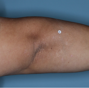PASI=1.10 Week 48