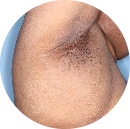 Patient intertriginous area image