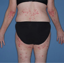 TREMFYA® patient with low-BSA at Week 0 back image