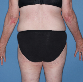 TREMFYA® patient with low-BSA at Week 16 back image