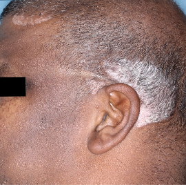 TREMFYA® patient with low-BSA at Week 0 head image
