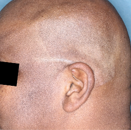 TREMFYA® patient with low-BSA at Week 16 head image