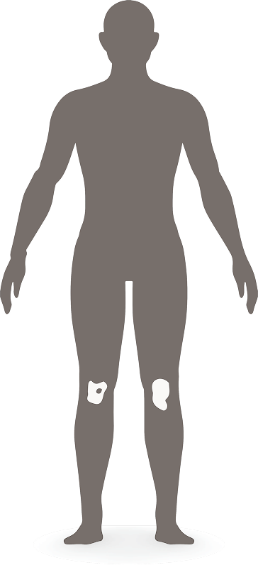 Mild PsO diagram