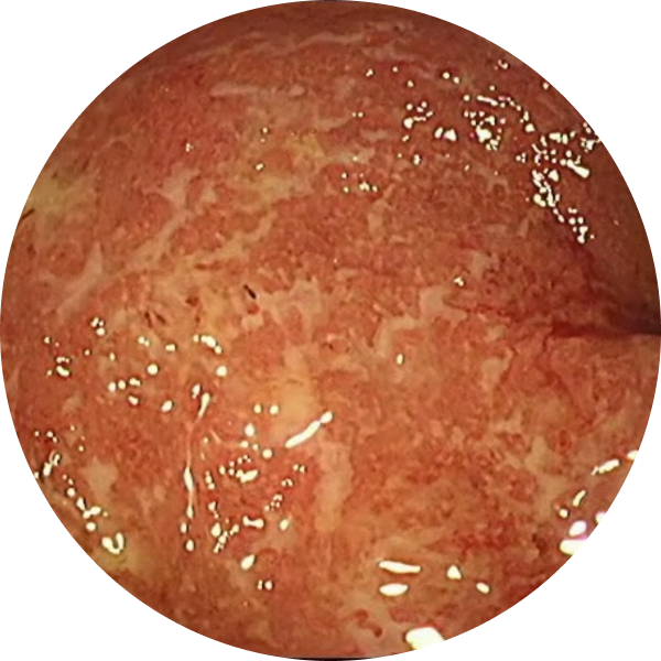 Endoscopic imagery from a real patient before TREMFYA® (guselkumab), Week 0