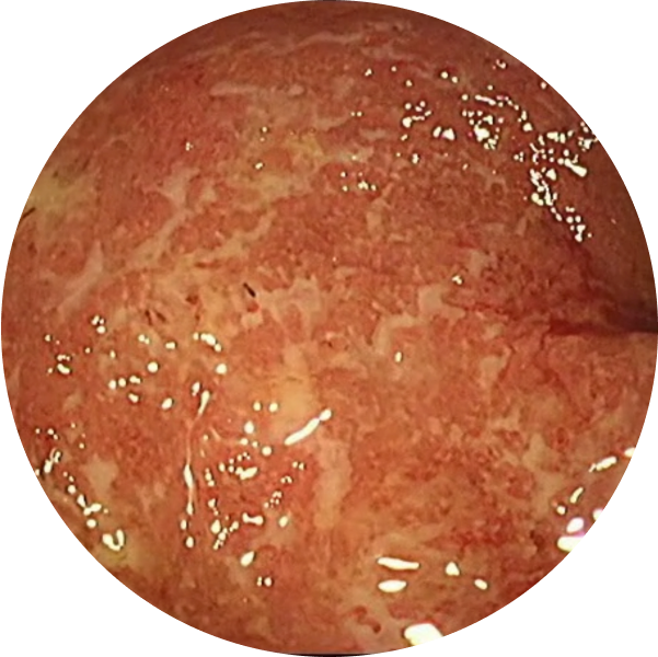 Endoscopic imagery from a real patient before TREMFYA® (guselkumab), Week 0