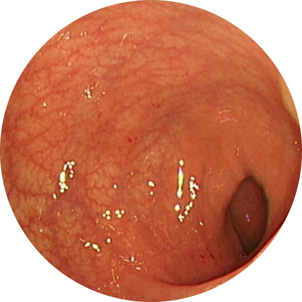 Endoscopic imagery from a real patient after TREMFYA® (guselkumab), Week 12