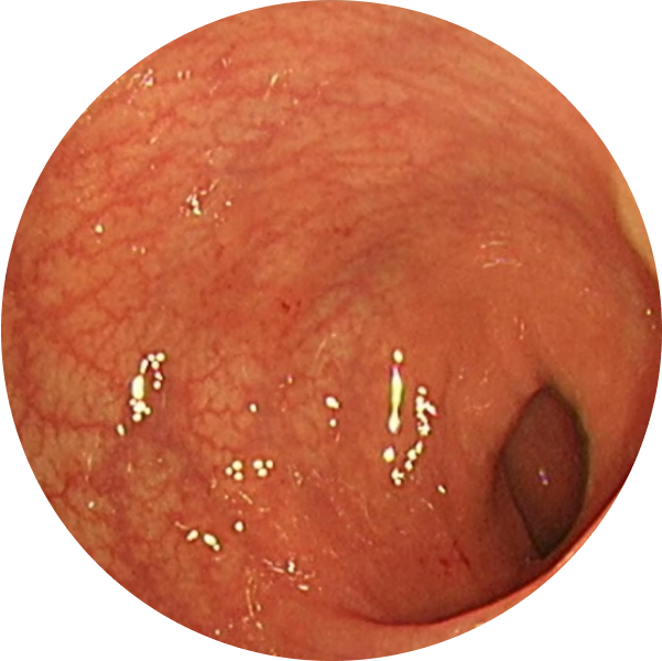Endoscopic imagery from a real patient after TREMFYA® (guselkumab), Week 12
