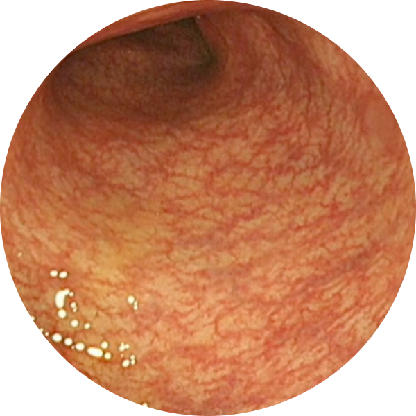 Endoscopic imagery from a real patient after TREMFYA® (guselkumab), Week 44