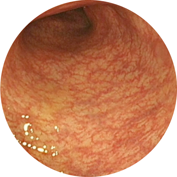 Endoscopic imagery from a real patient after TREMFYA® (guselkumab), Week 44
